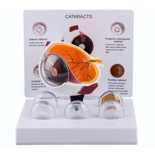Eye Model, Anatomical Eyeball Model with Cataract Display for Human Anatomy, Physiology Education, Science Classroom Study Medical Education